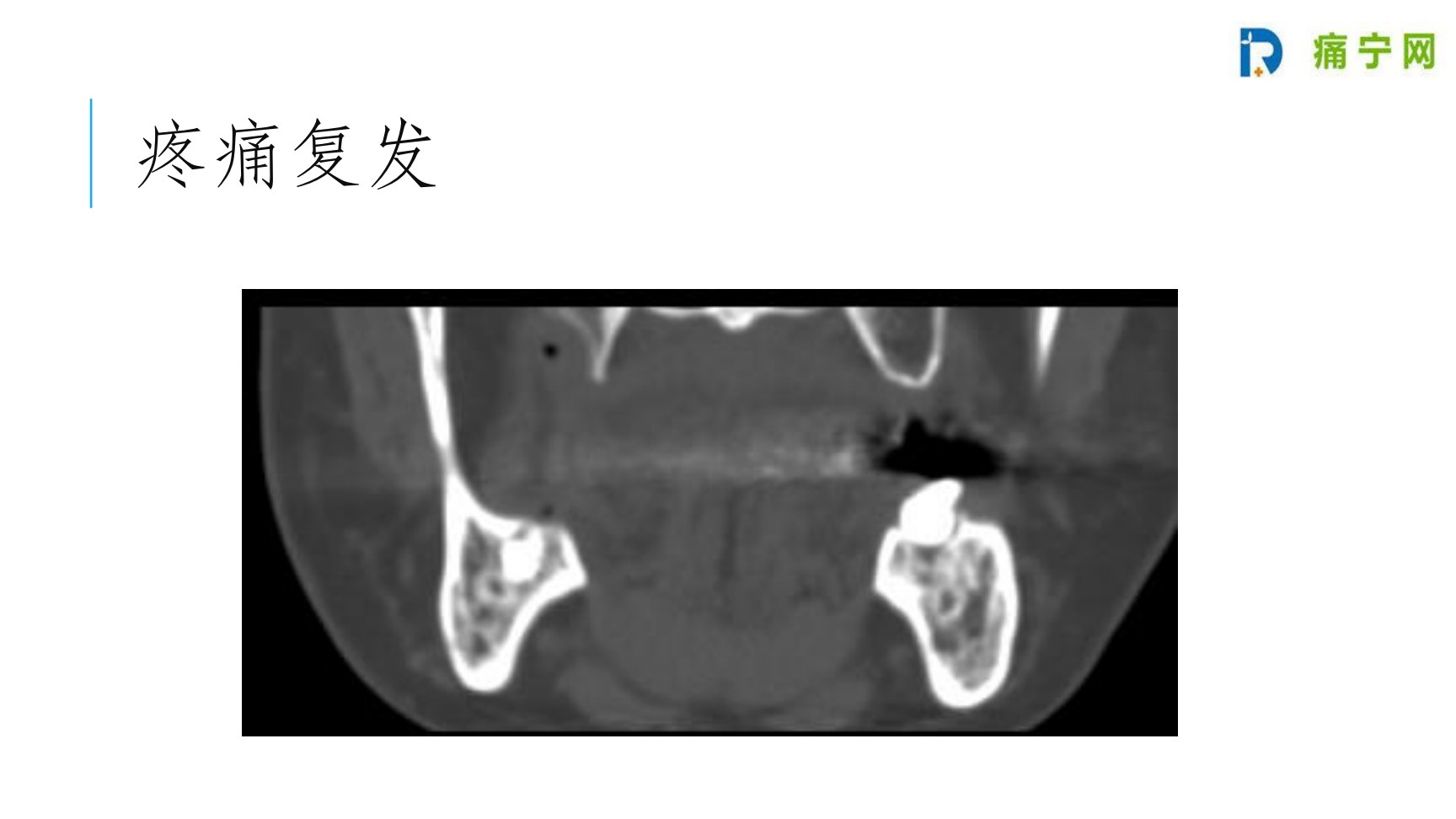 病例1 疼痛复发:薄层CT显示牙根根尖残留,炎症侵及下牙槽神经管