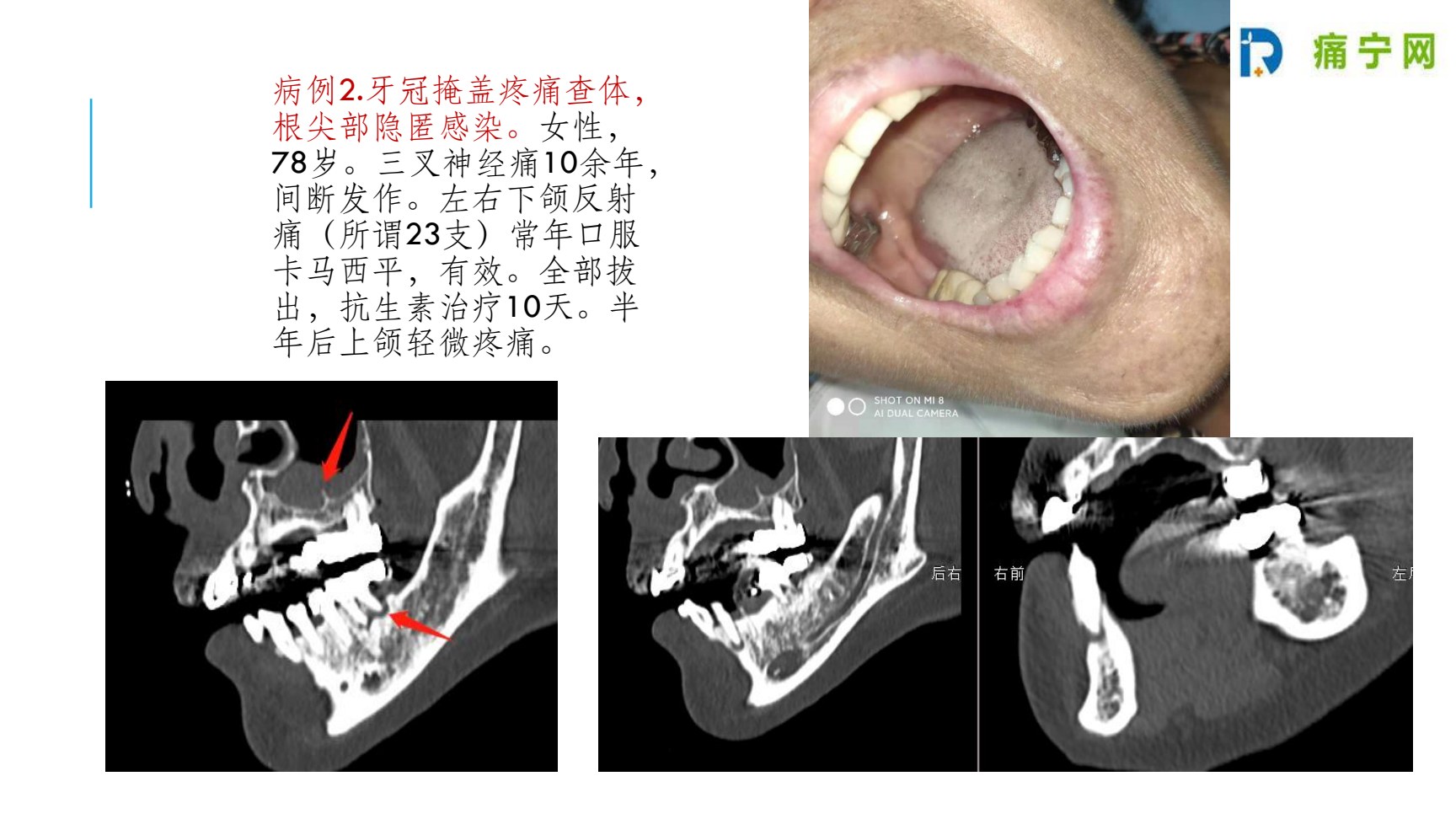 病例2 牙冠掩盖疼痛查体:口腔照片与口腔CT
