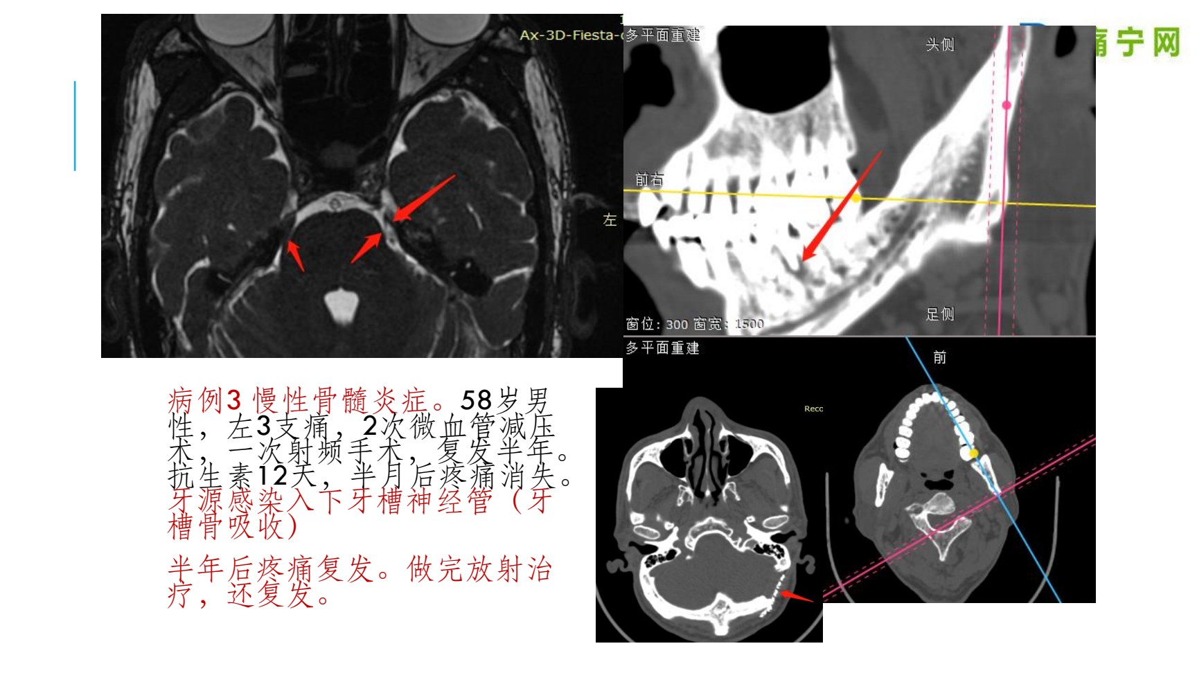 病例3 慢性骨髓炎症:CT影像