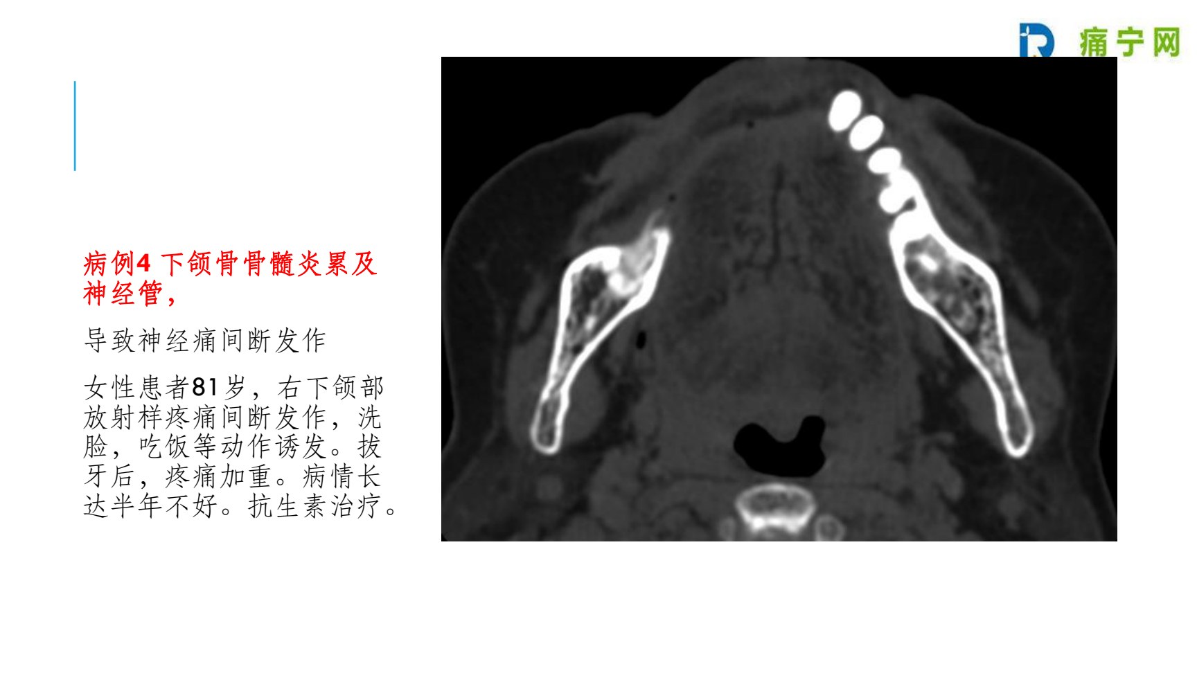病例4 下颌骨骨髓炎累及神经管:CT影像