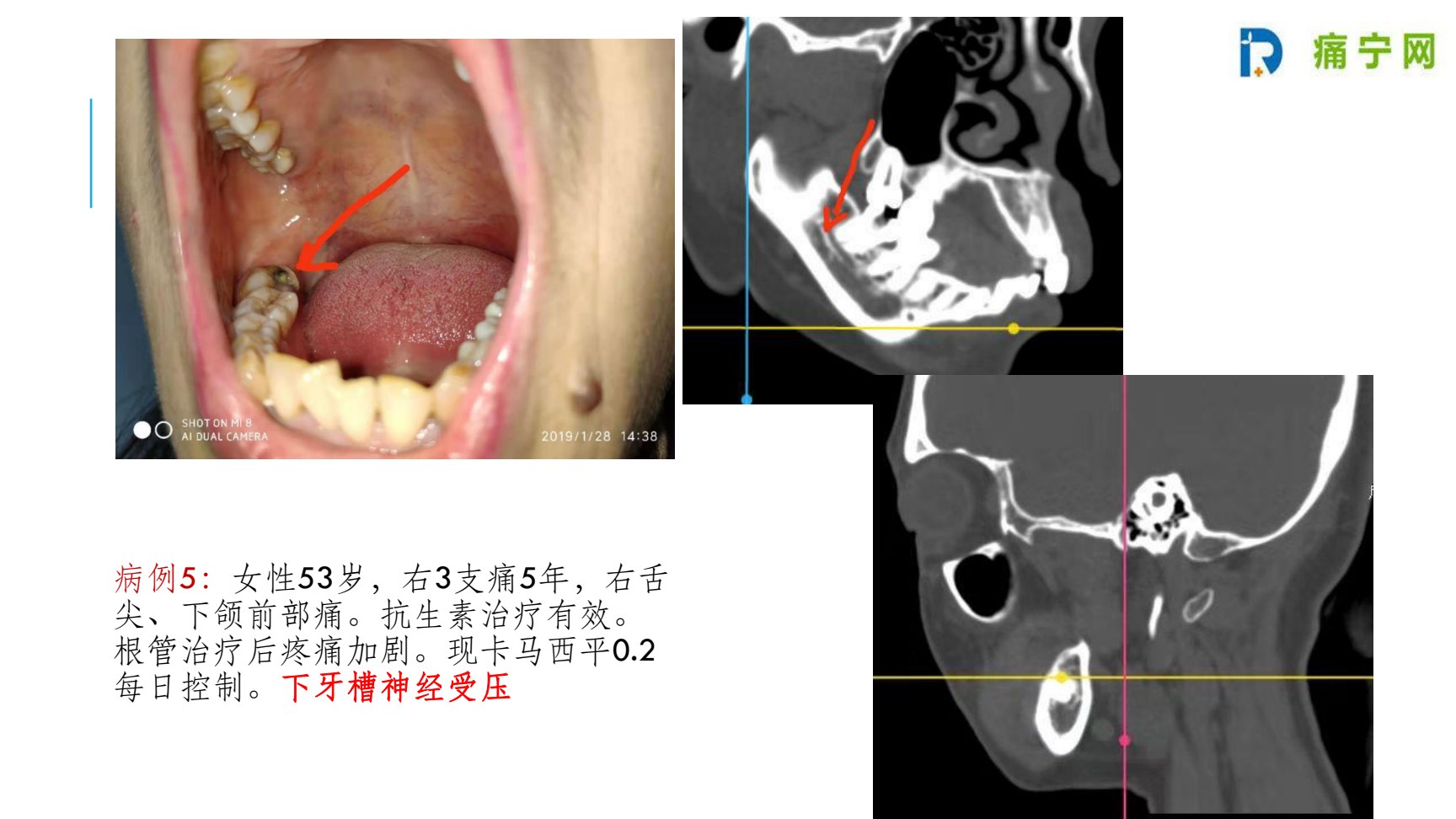 病例5 下牙槽神经受压:口腔CT