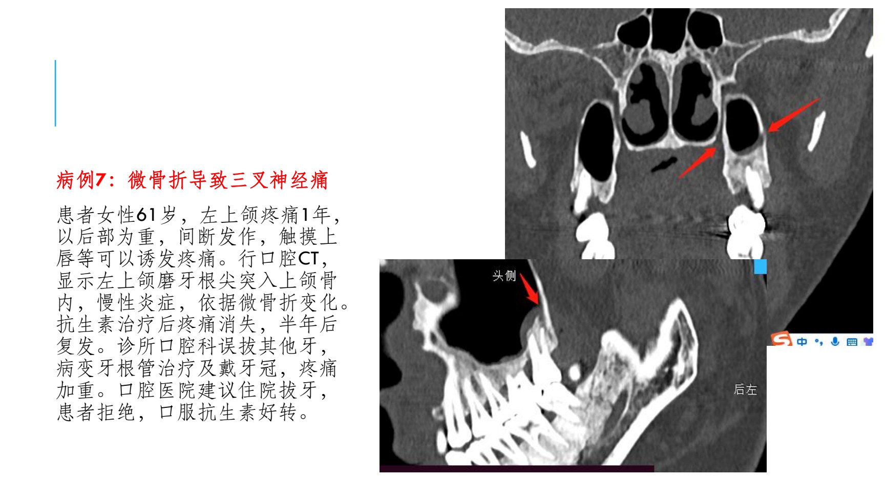 病例7 微骨折:口腔CT显示磨牙根尖突入上颌骨内