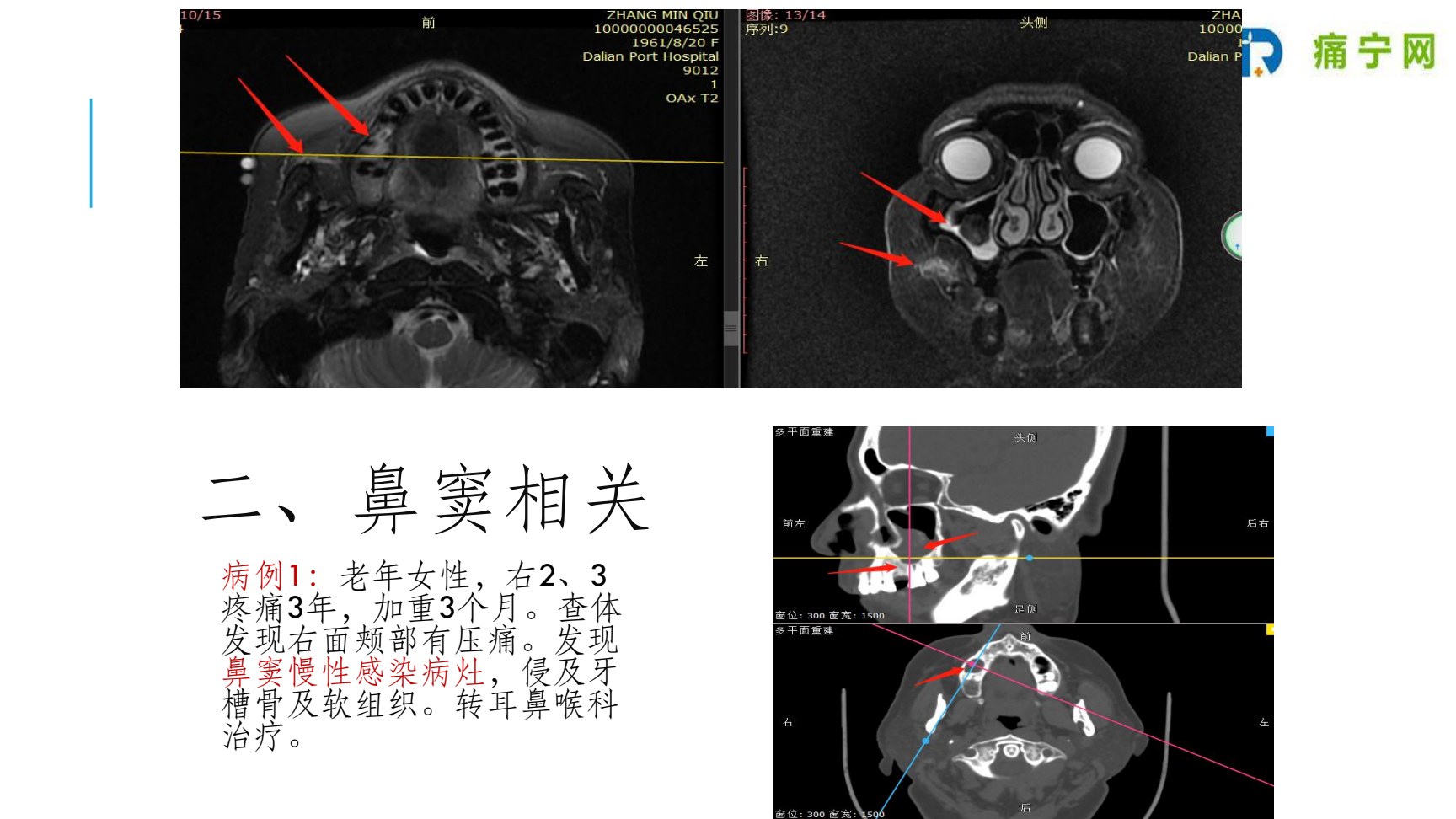 鼻窦病例1:鼻窦慢性感染侵及牙槽骨及软组织