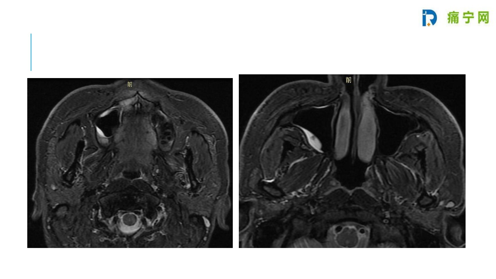 鼻窦病例2:上颌骨感染导致上颌神经痛,颌面部MRI