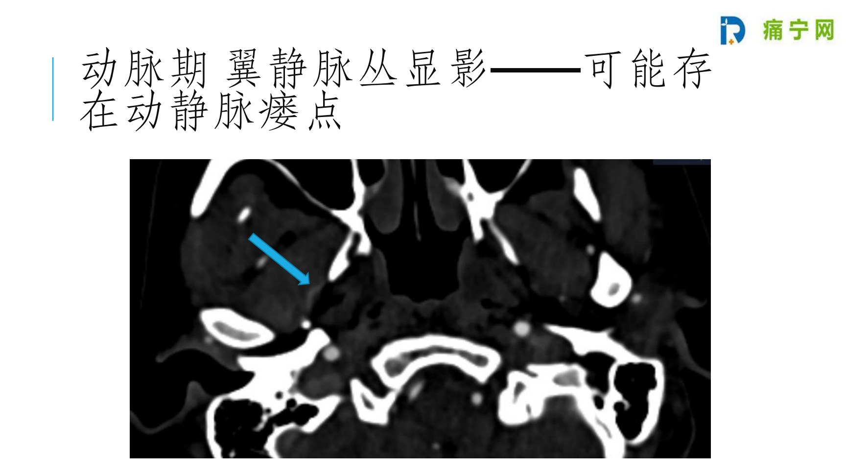 动脉期出现翼静脉丛显影,提示可能存在动静脉瘘点