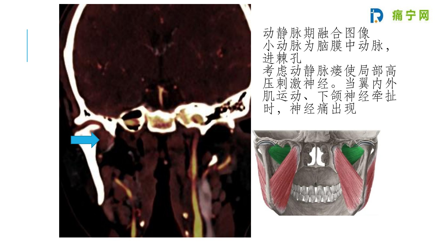 动静脉期融合图像:小动脉为脑膜中动脉,进棘孔