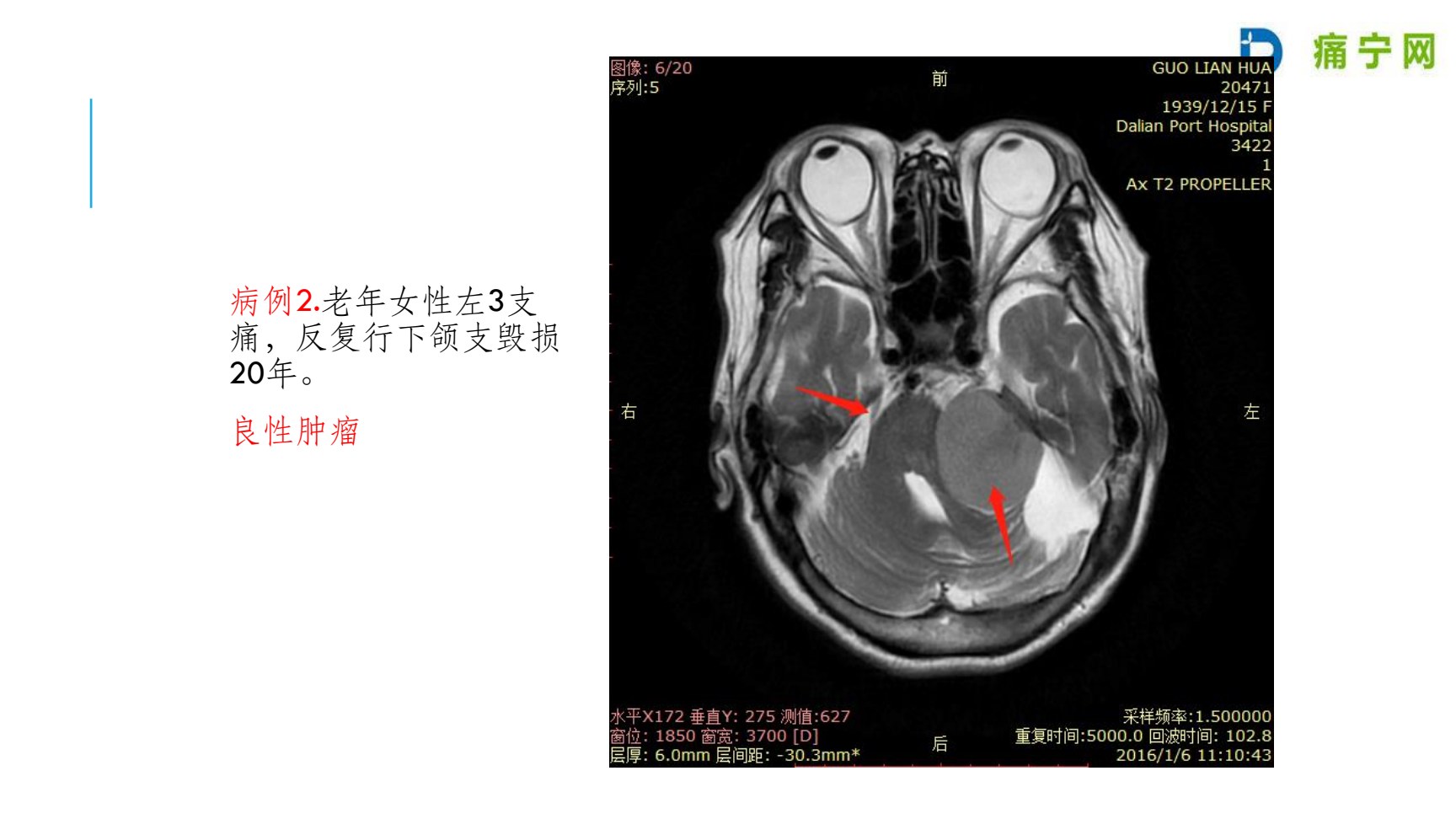 医源性病例2:反复行下颌支毁损20年,实为良性肿瘤