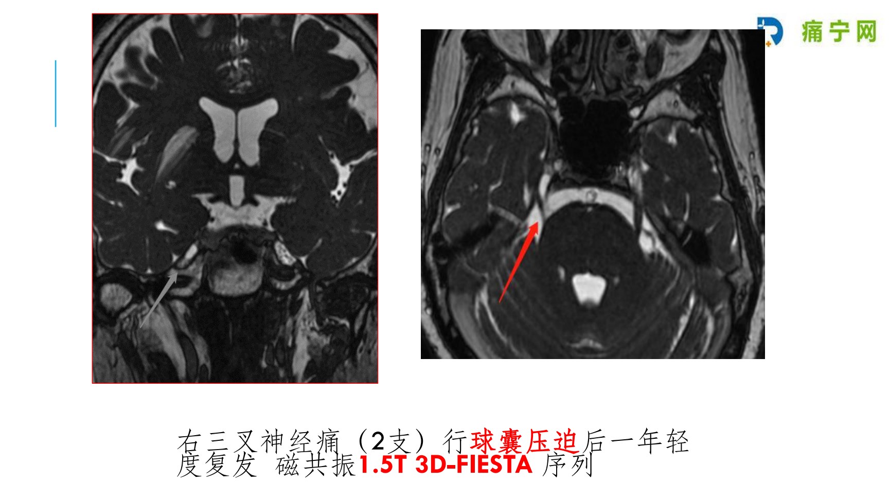 颅内段磁共振 3D-FIESTA 序列:三叉神经根、脑干与邻近血管的关系